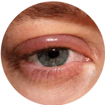 Illustration representing eye and skin irritation